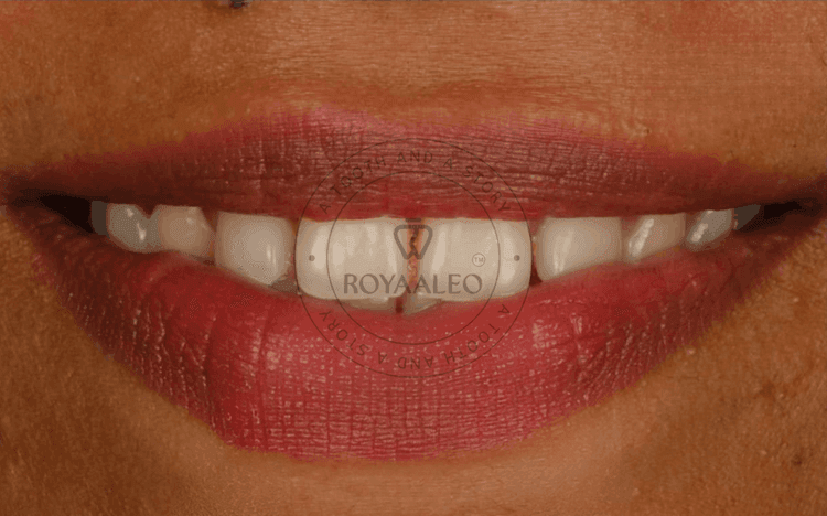 Smile Correction with 5 Composite Restorations