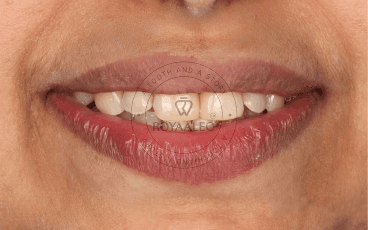Composite Smile Correction – 10 Teeth