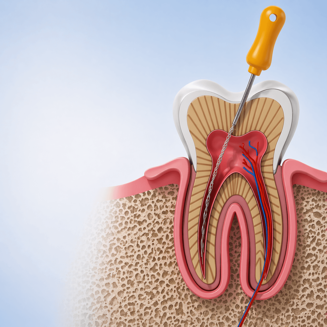 Root Canal